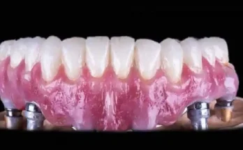 The Importance Of Sterility In A Dental Implant Clinic