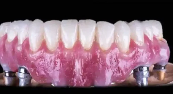 The Importance Of Sterility In A Dental Implant Clinic